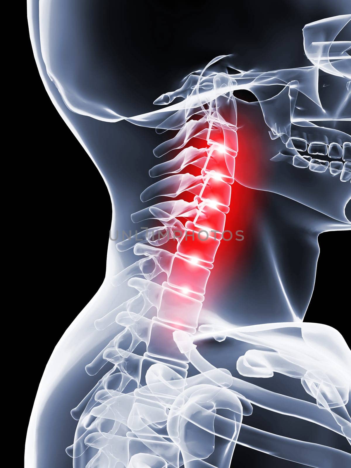 3d rendered x-ray illustration of a human neck with pain