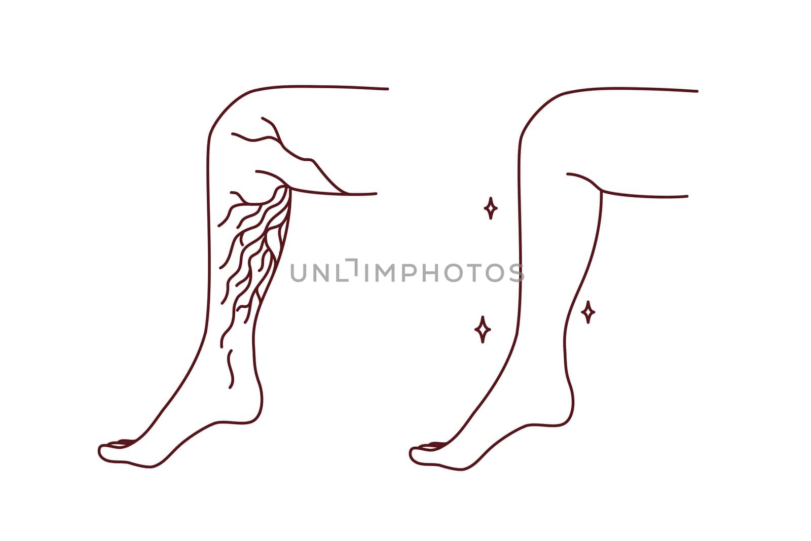 Close-up of unhealthy and healthy leg with varicose veins. Patient suffer from varicoses. Healthcare and medicine. Vector illustration.