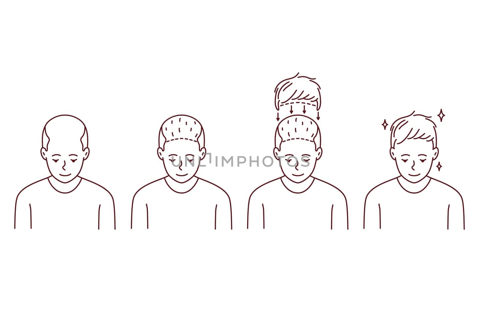 Stages on man hair transplant. Treatment of baldness and alopecia. Set of male patient follicular unit extraction. Vector illustration.