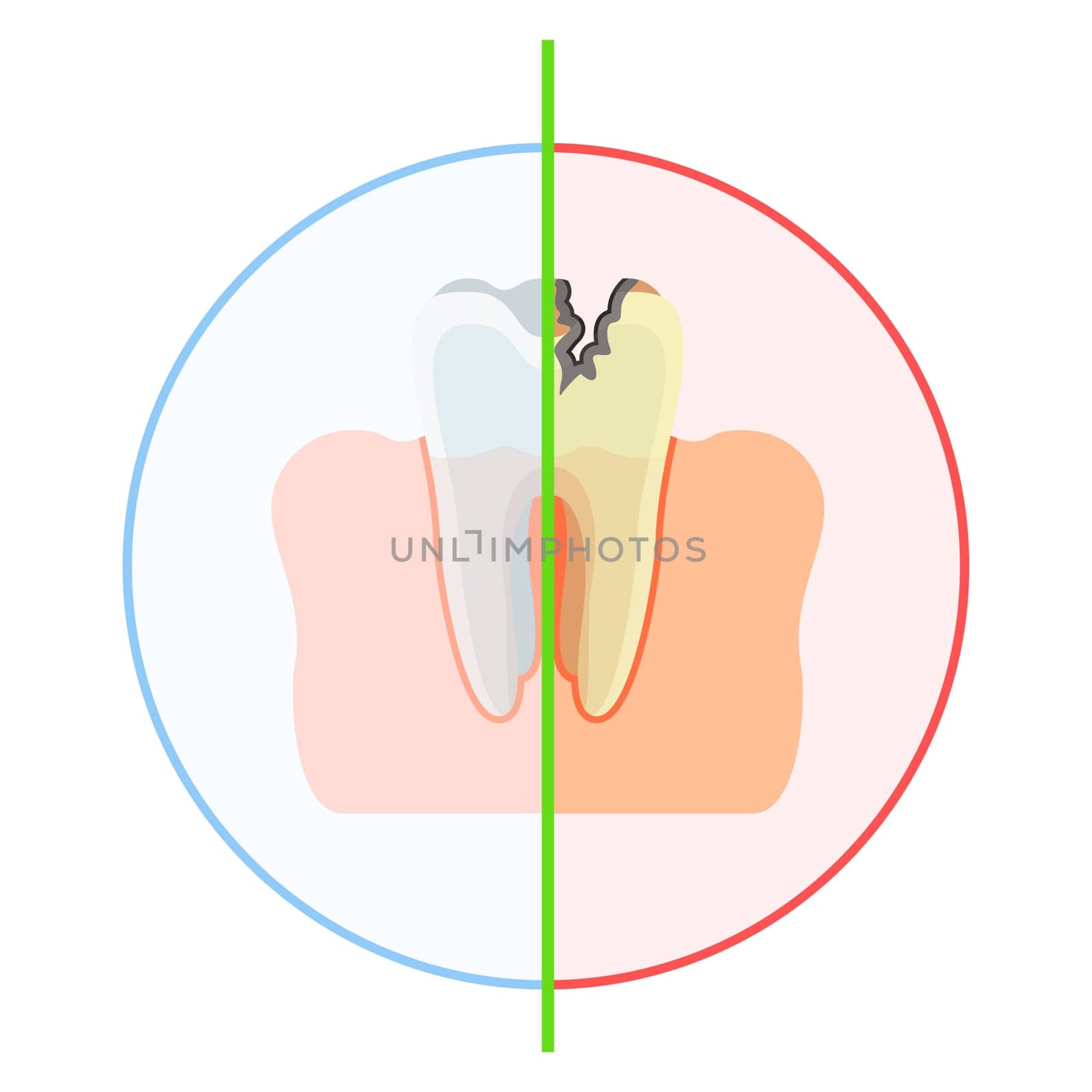 Tooth is healthy and damaged by caries, with hole. Flat vector cartoon illustration. Objects isolated on white background.