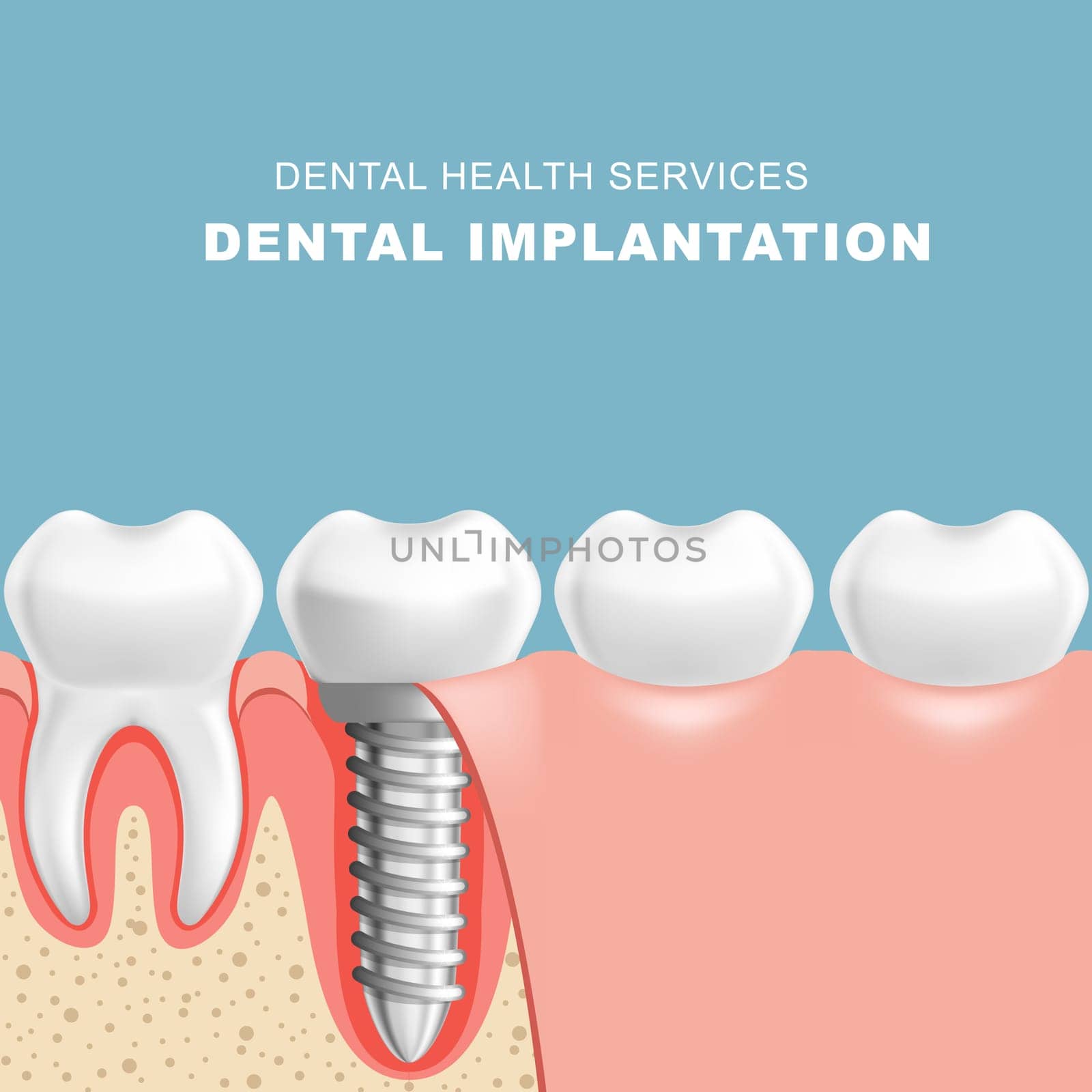 Gum section with dental implantat - row of teeth