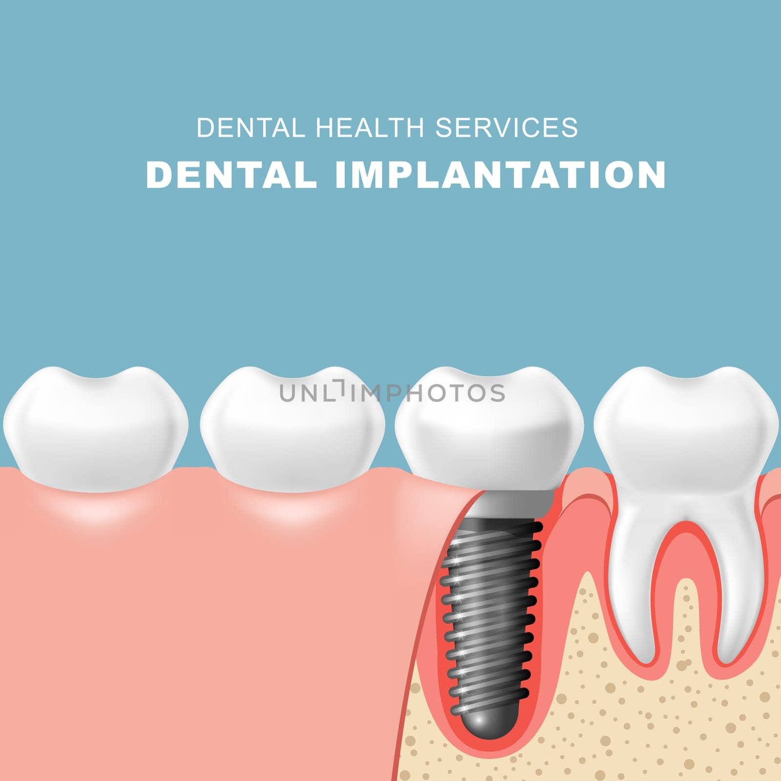 Teeth and dental implantat inserted into gum - tooth implantation