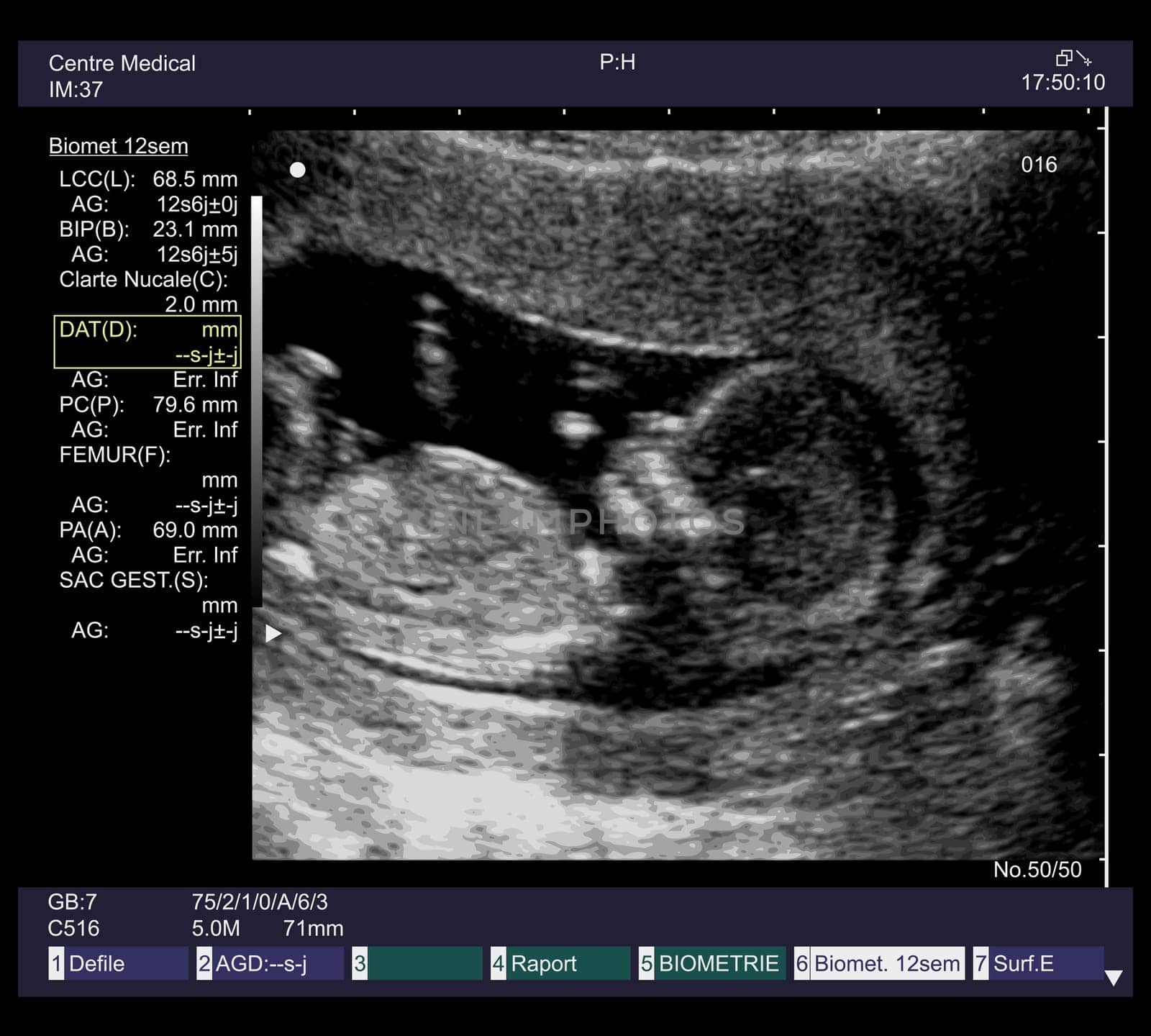 ultrasound fetus at 12 weeks