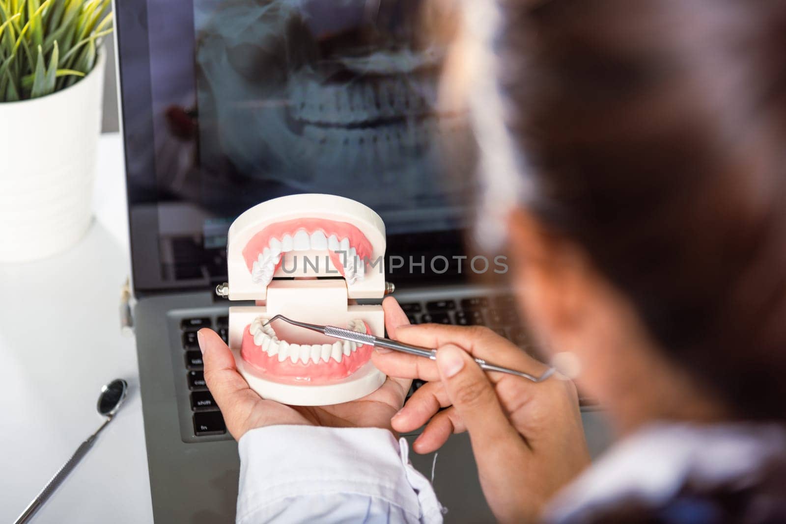 Oral dental hygiene. Dentist female holding professional stomatology tool and pointing healthy tooth model and explaining patient at clinic office and teeth X-ray on laptop screen, dental healthcare
