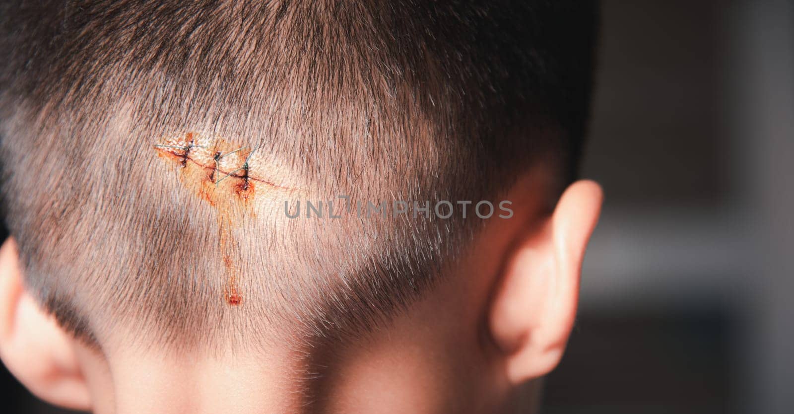 The lacerated sutured wound of kid back head which suture by nylon suture about 3 stitches at the emergency room of the hospital, Medical care of the surgery lesion on the head, children of Accident
