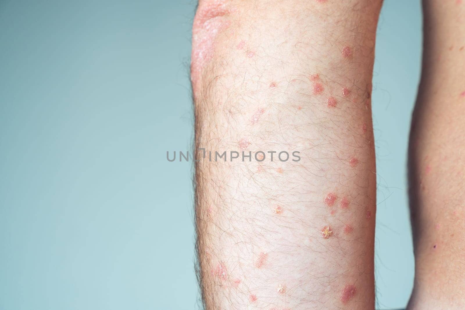 Close-up of bare elbow of unrecognizable man showing inflamed scaly flaky affected skin suffering from psoriasis on blue background. Autoimmune incurable skin disease, health, dermatology. Side view.