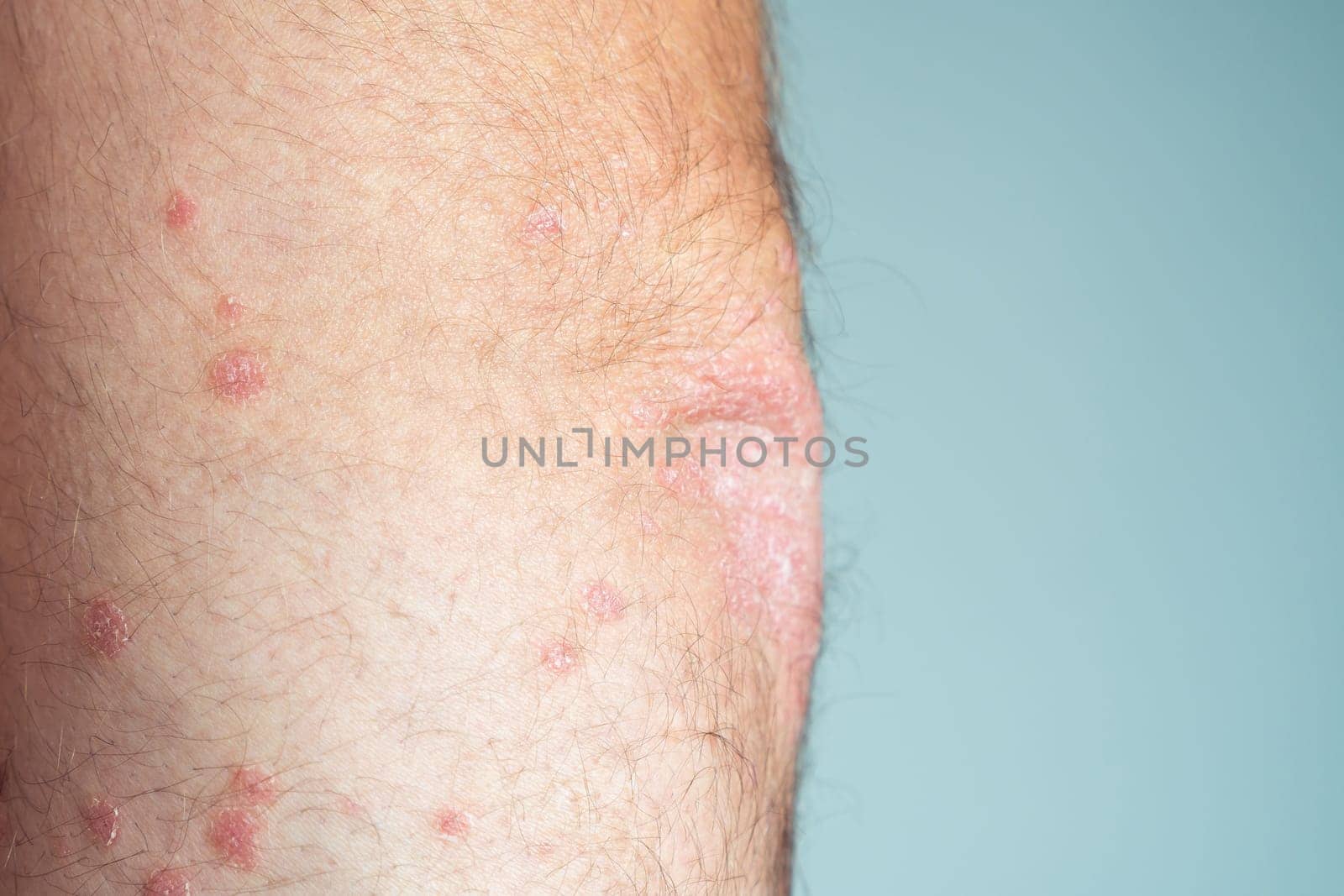 Close-up of bare elbow of unrecognizable man showing inflamed scaly flaky skin suffering from chronic psoriasis on blue background. Autoimmune incurable skin disease, health, dermatology. Side view.