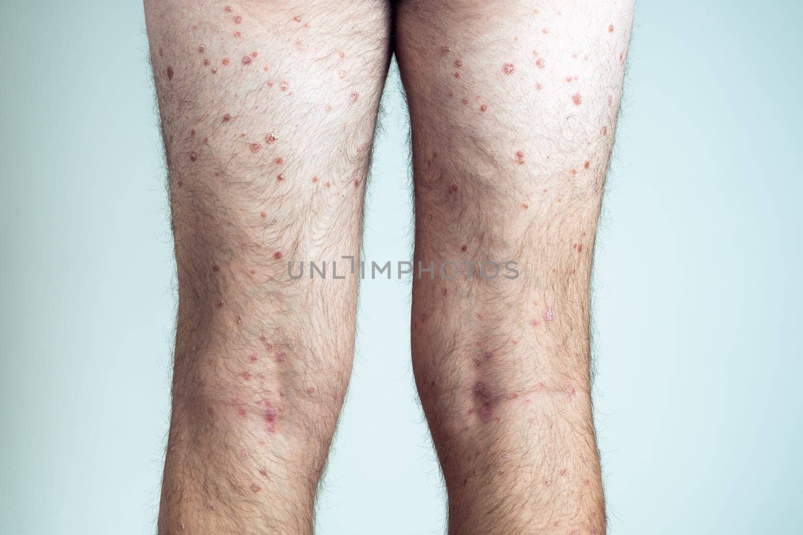 Back view of of bare legs of unrecognizable man showing inflamed scaly flaky skin suffering from psoriasis on blue background. Autoimmune incurable skin disease, healthcare, skincare, dermatology.