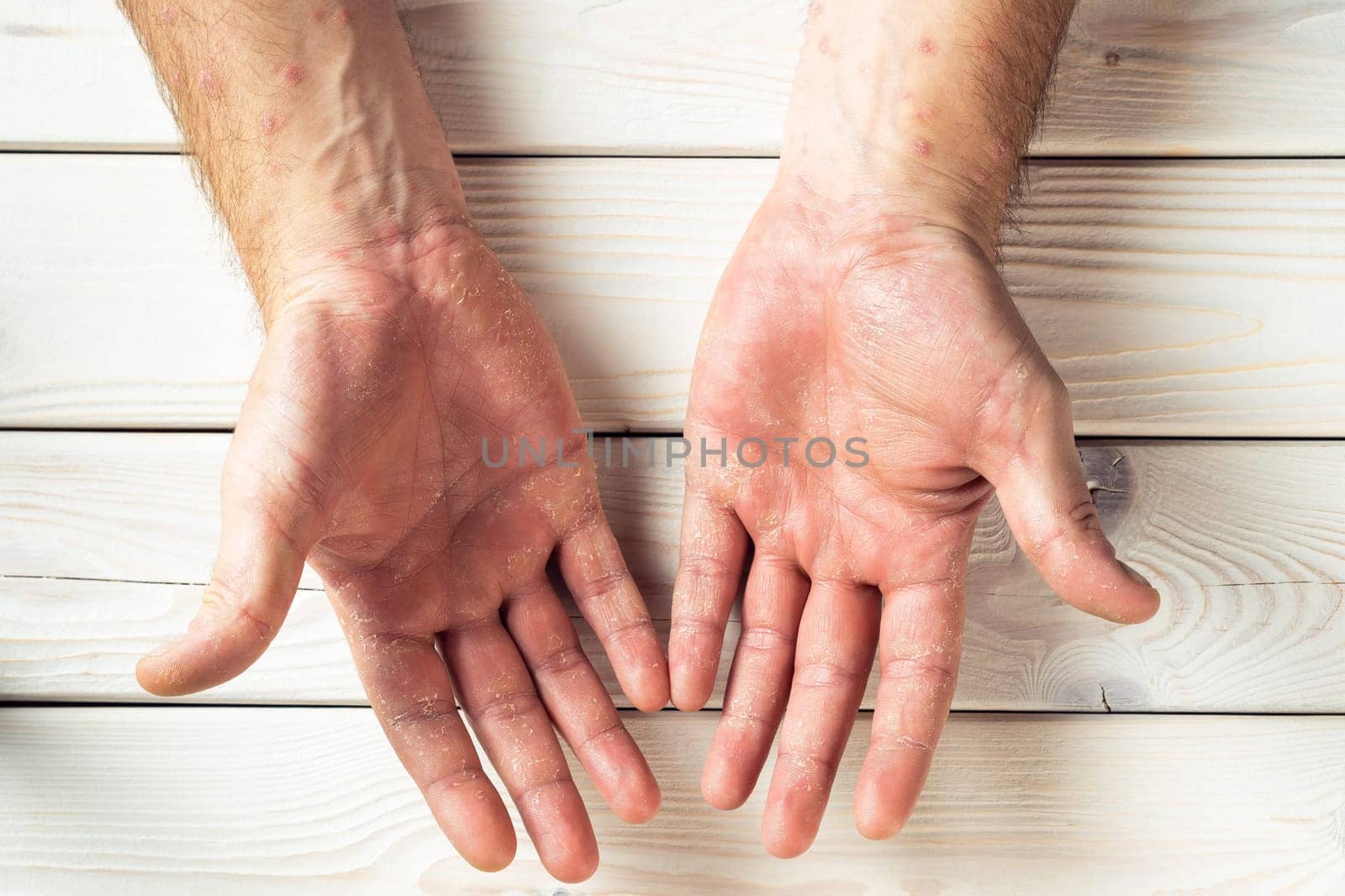 Top view of unrecognizable man suffering from psoriasis, showing dry thick scaly clusters, inflamed rash on skin of palms on white wooden background. Health, autoimmune genetic disease, dermatology.