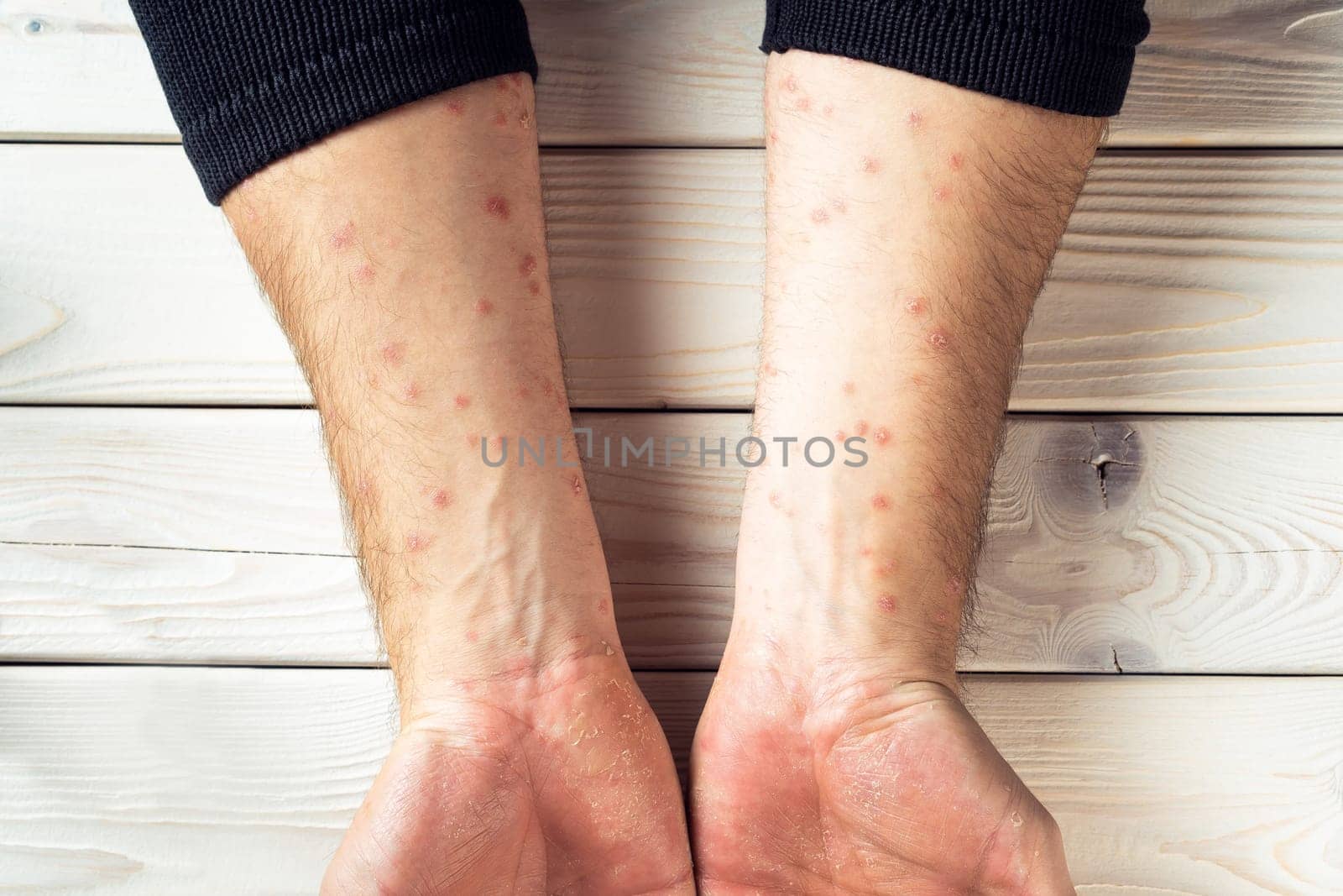 Top view of unrecognizable man suffering from psoriasis, showing thick scaly clusters, red inflamed rash on skin of arm on white wooden background. Healthcare, autoimmune genetic disease, dermatology.