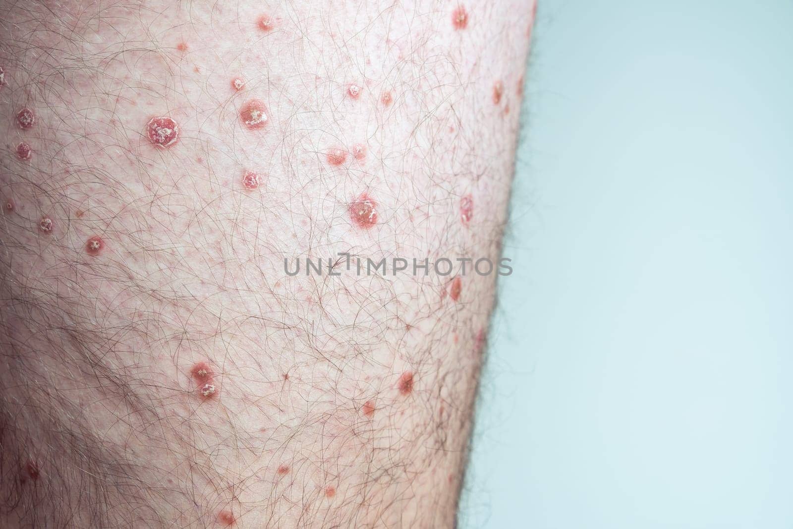 Closeup of red inflamed flaky affected hairy scaly skin of leg of unrecognizable man suffering from psoriasis on blue background. Health, skincare, autoimmune incurable skin disease, dermatology.