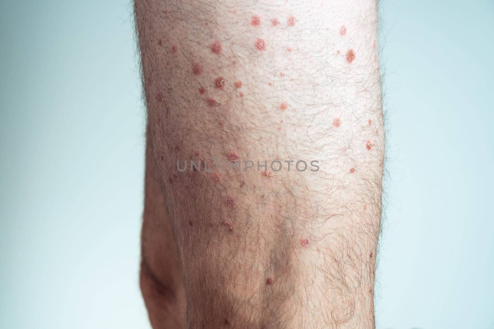 Side view of of bare legs of unrecognizable man showing inflamed scaly flaky skin suffering from psoriasis on blue background. Autoimmune incurable skin disease, healthcare, skincare, dermatology.