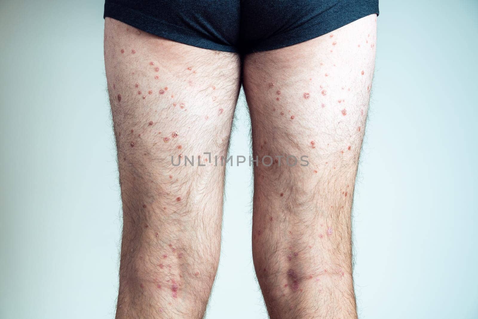 Back view of of bare legs of unrecognizable man wearing black underpants showing red inflamed scaly skin suffering from psoriasis on blue background. Autoimmune incurable skin disease, dermatology.