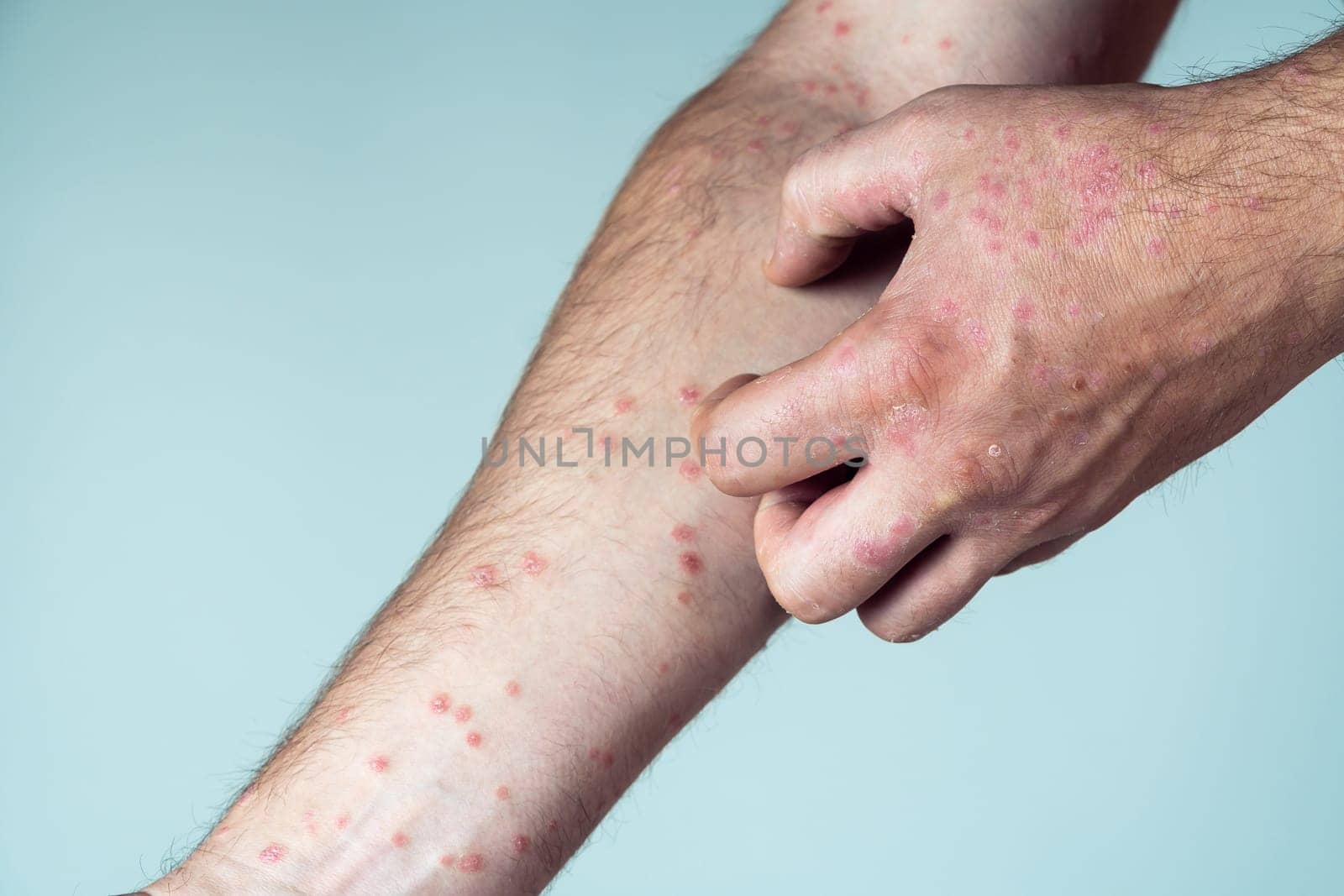 Cropped photo of man suffering from psoriasis scratching thick scaly clusters, red rash on skin of arm with affected fingers on blue background. Health, autoimmune incurable skin disease, dermatology.