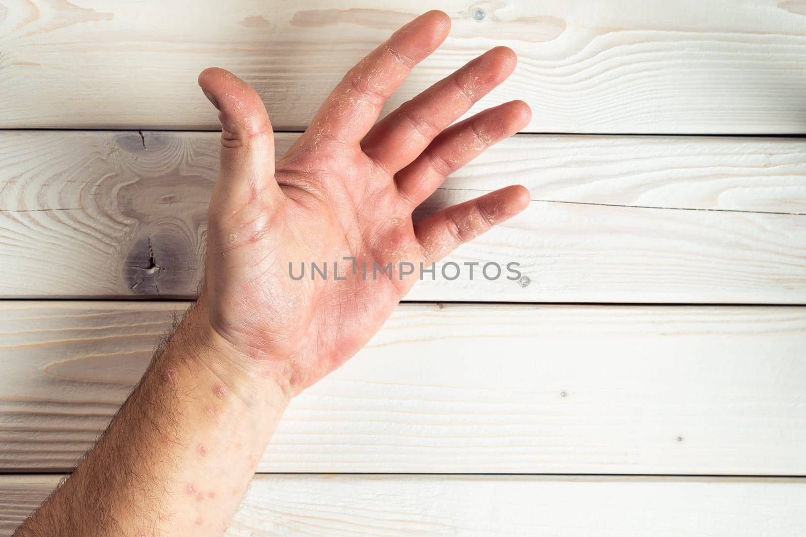 Top view of unrecognizable man suffering from psoriasis, showing thick scaly clusters, rash on skin of palm, fingers, arm on white wooden background. Health, autoimmune genetic disease, dermatology.