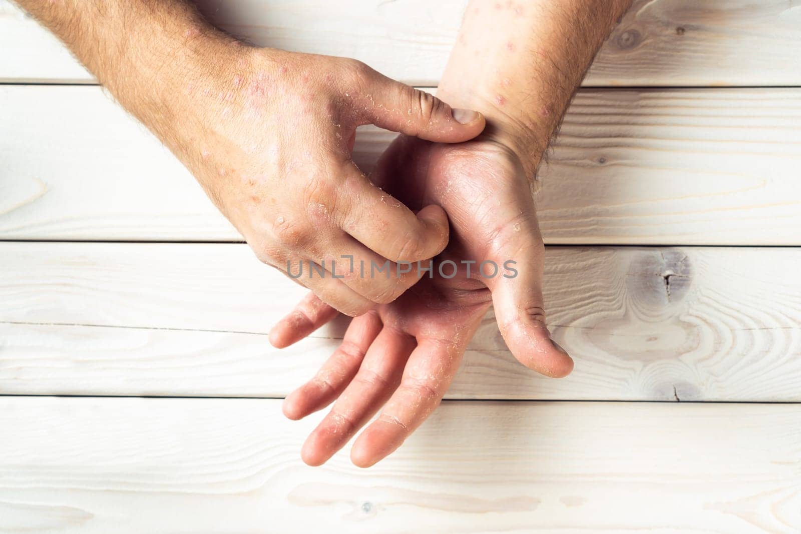 Top view of unrecognizable man suffering from psoriasis, scratching inflamed, flaky rash on skin of palm with fingers on white wooden background. Healthcare, autoimmune genetic disease, dermatology.