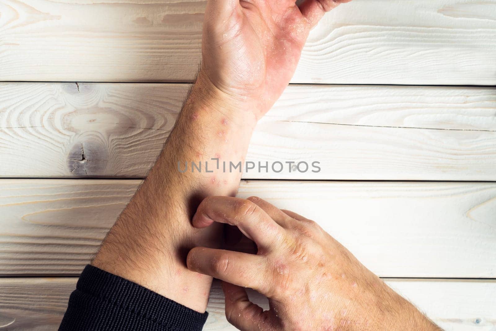 Top view of unrecognizable man suffering from psoriasis, scratching red, inflamed, flaky rash on skin of arm with fingers on white wooden background. Health, autoimmune genetic disease, dermatology.