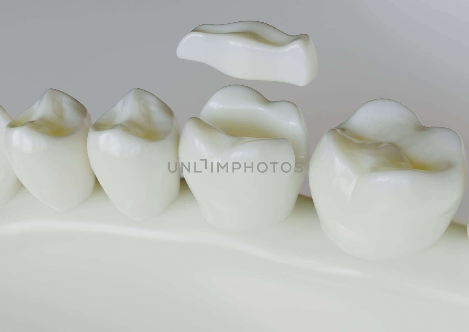 Ceramic Inlay crown over a totth - 3D Rendering