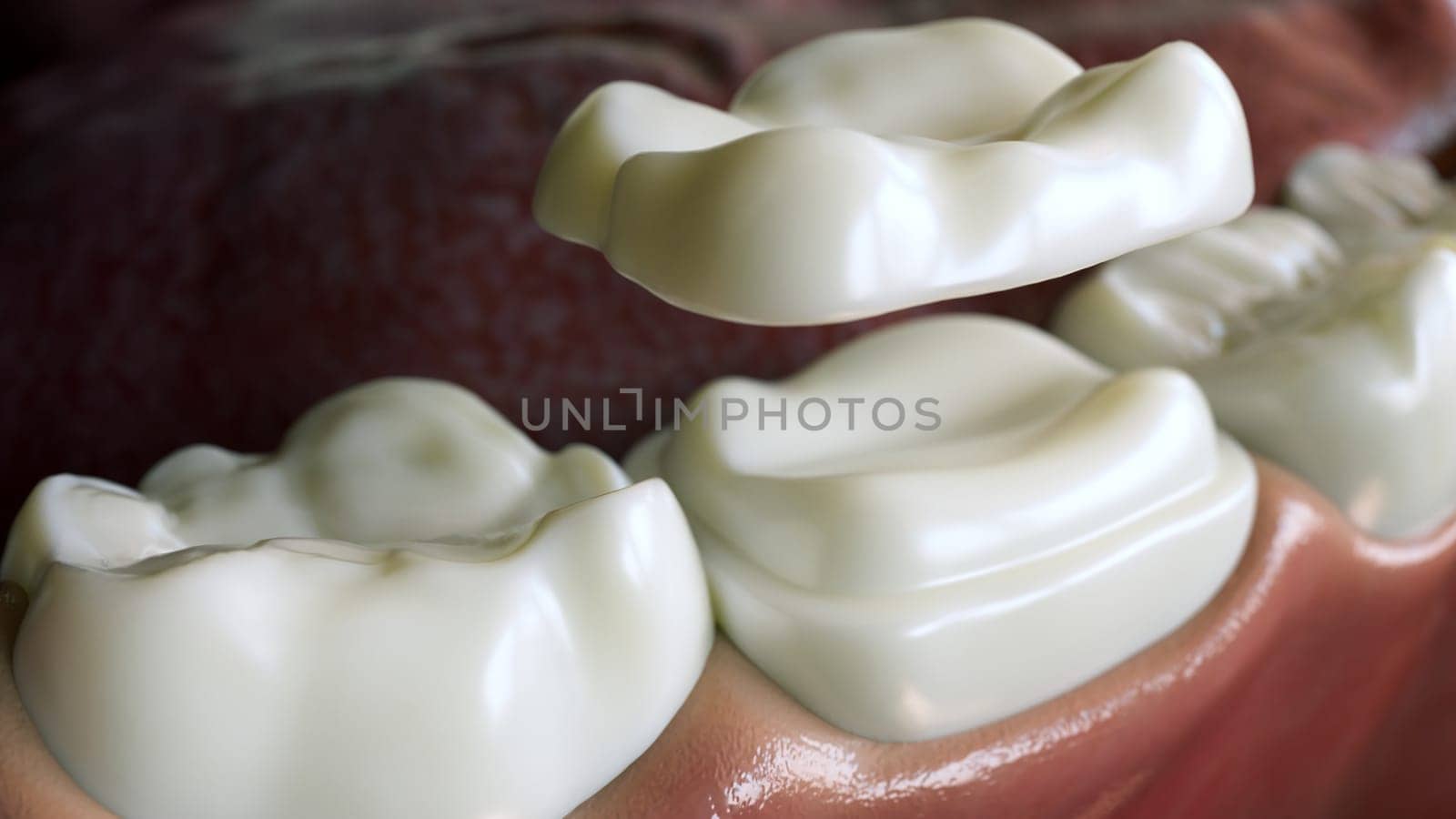 Ceramic Overlay crown over a tooth- 3D Rendering