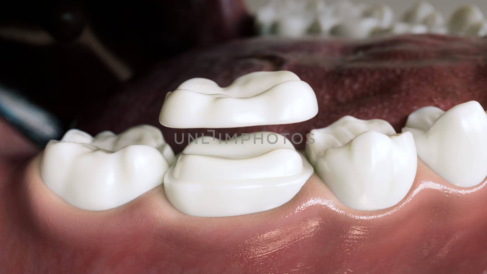 Ceramic Overlay crown over a tooth- 3D Rendering