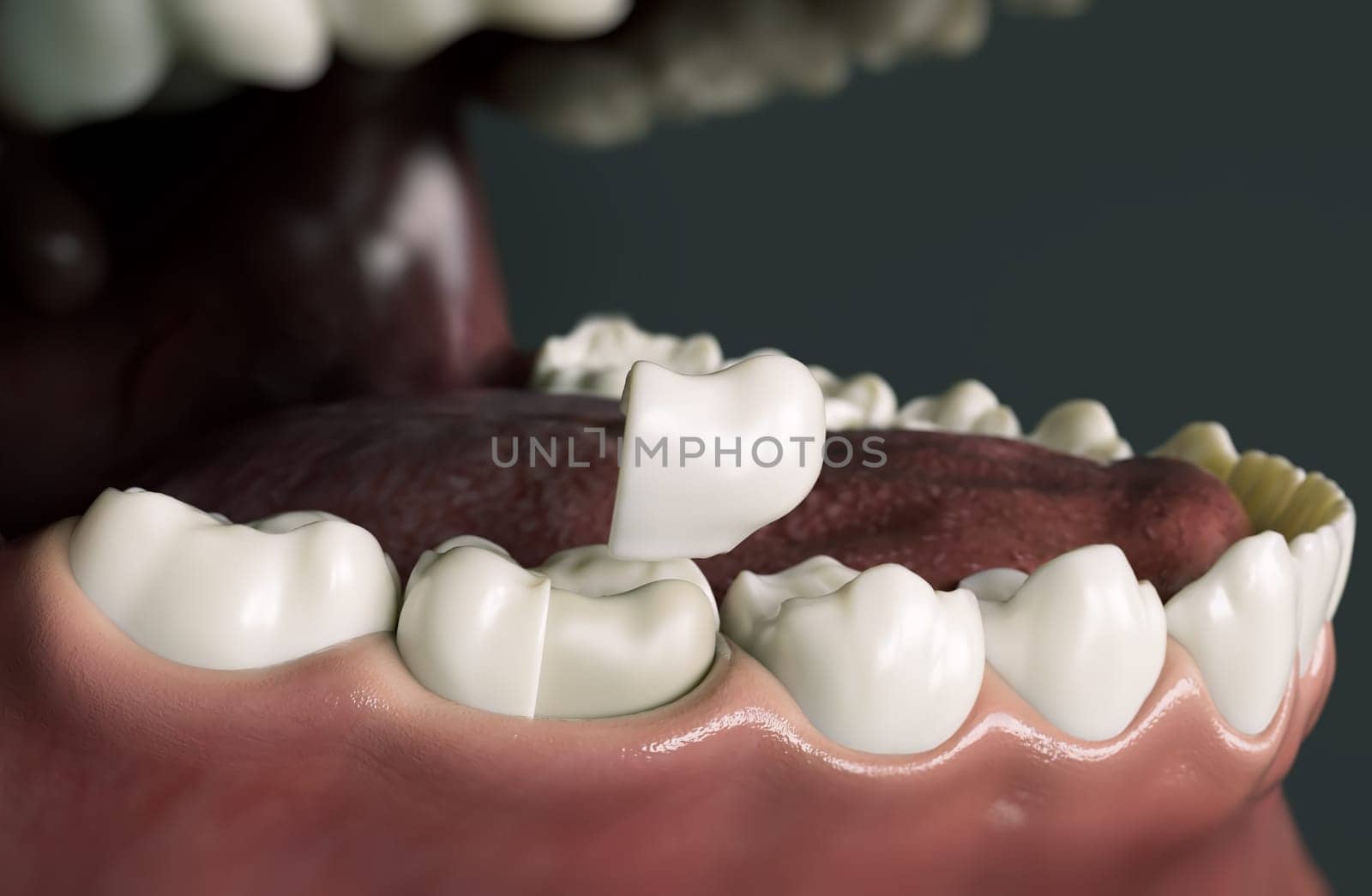 Ceramic Onlay quarter crown over a tooth- 3D Rendering