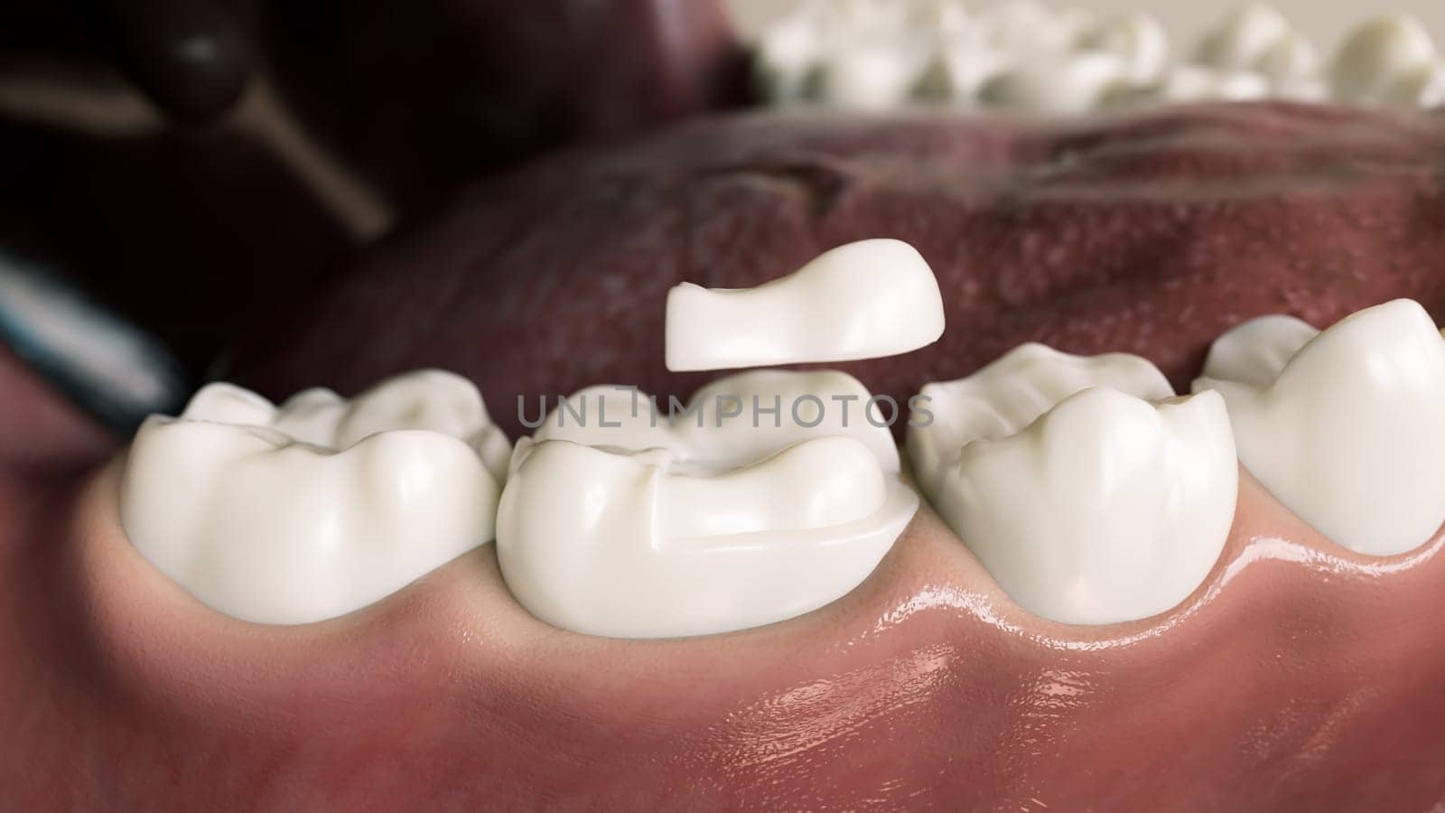 Ceramic Onlay quarter crown over a tooth- 3D Rendering