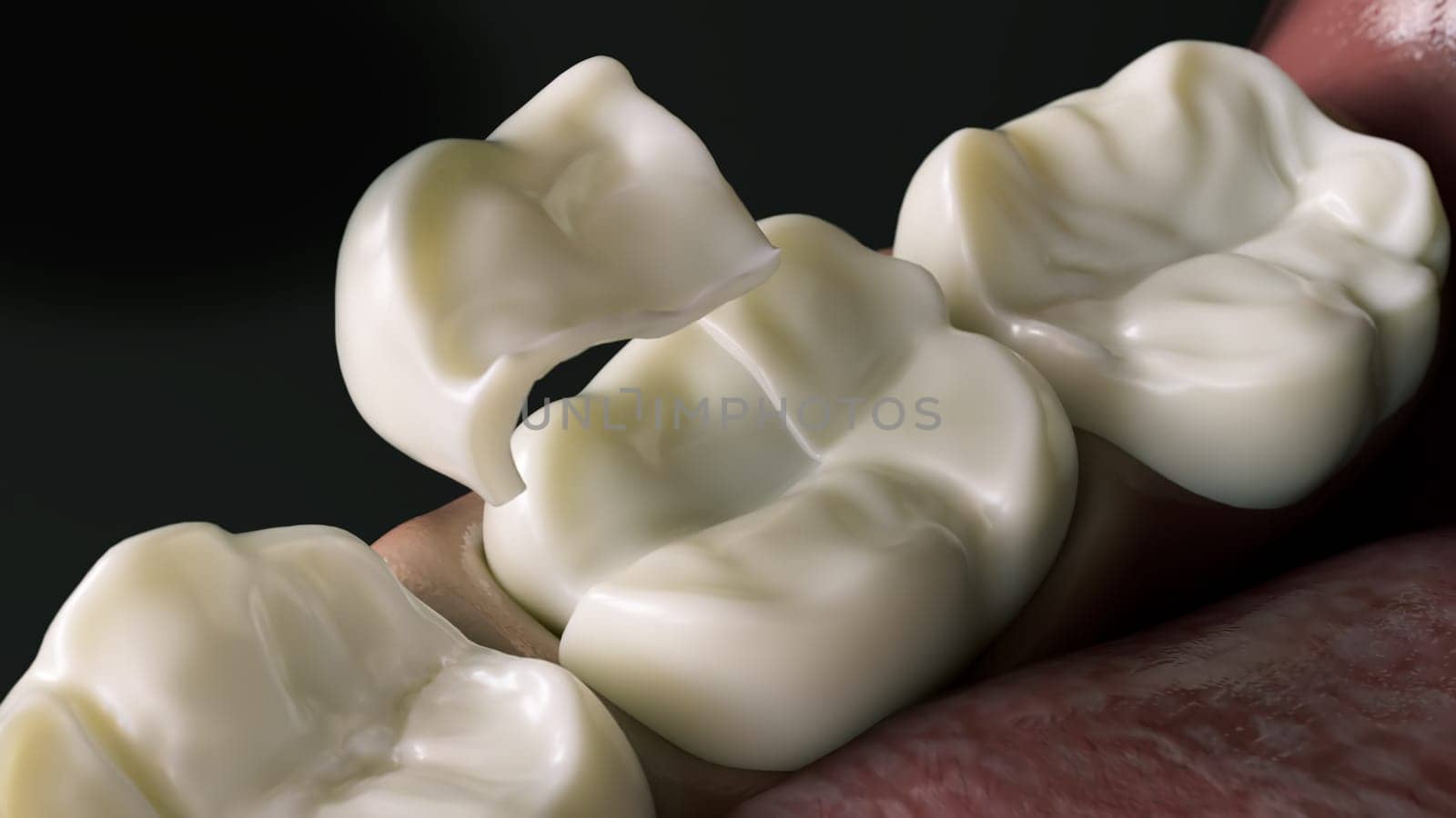 Ceramic Onlay quarter crown over a tooth- 3D Rendering