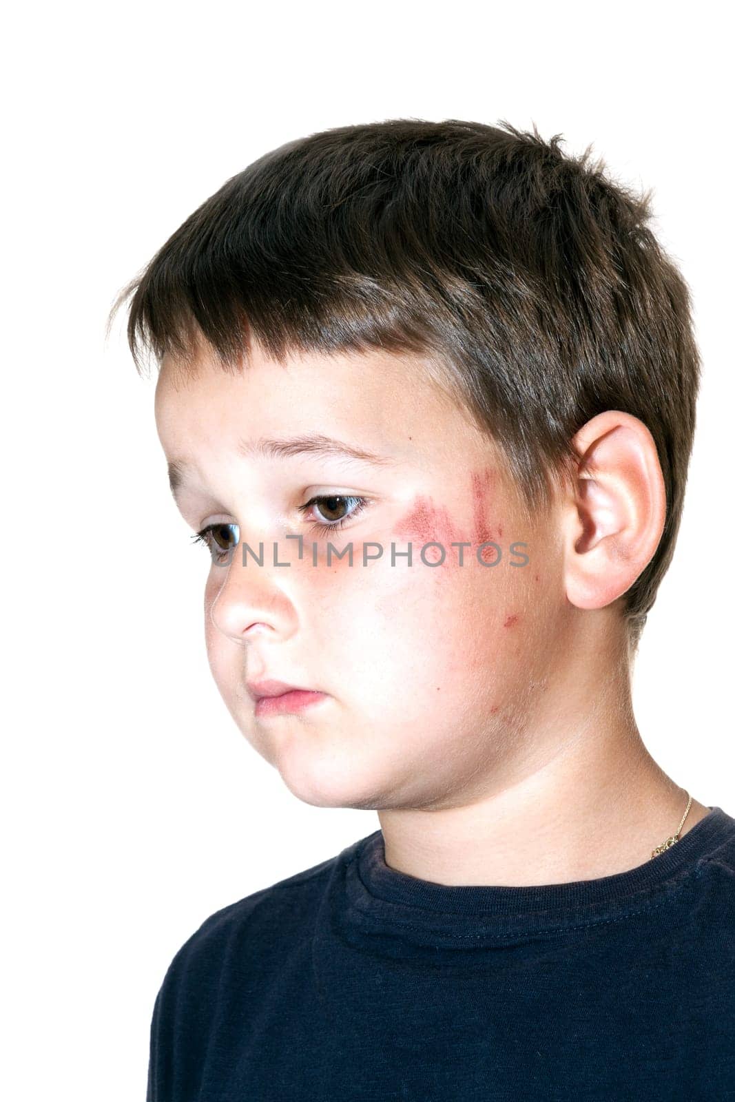 sad boy with a scraped face