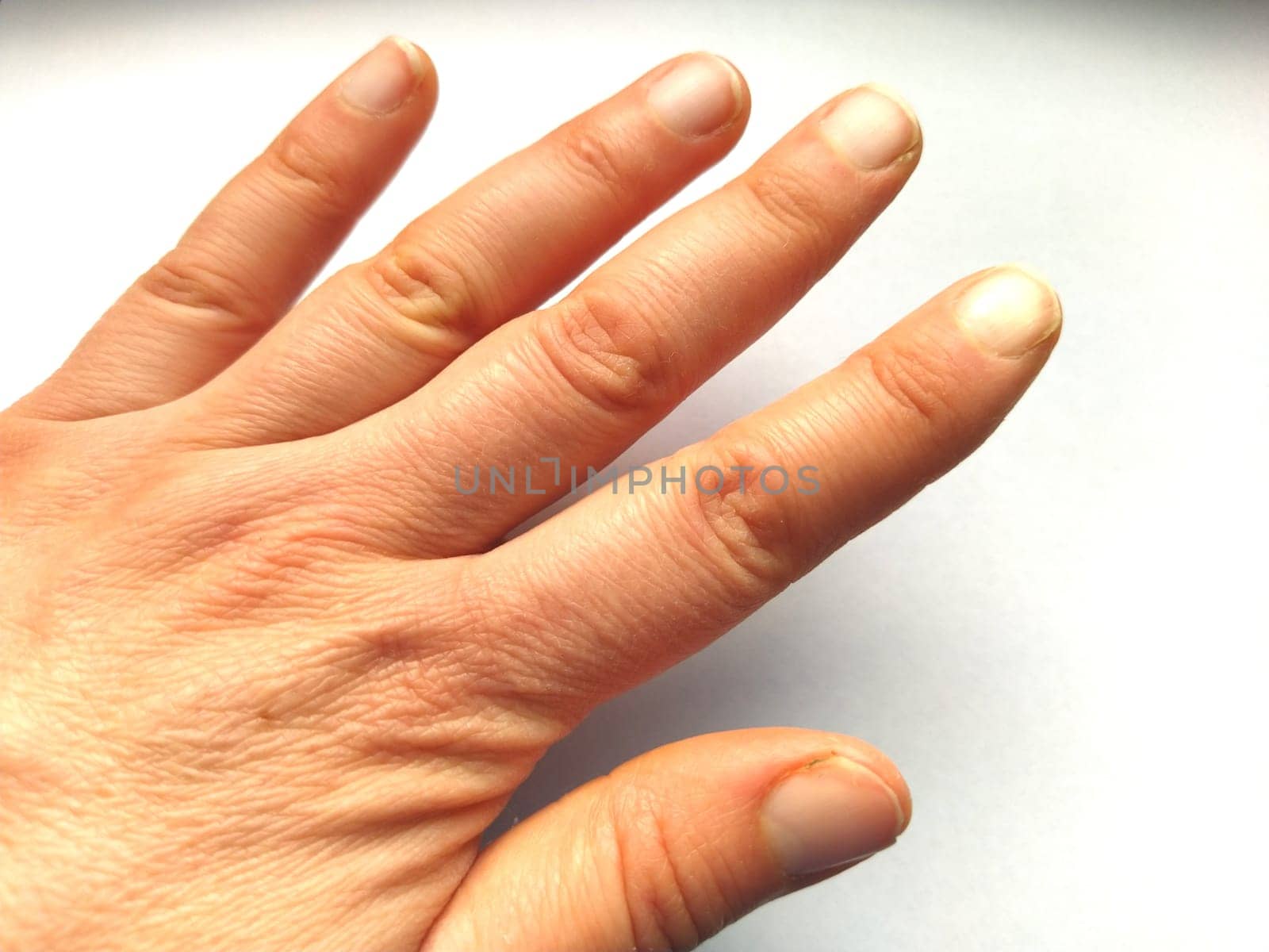 Female hand with dry atopic skin. White background. Close-up of the skin on the hands and fingers. Derma in need of care and hydration. Wrinkles, dryness and surface irritation. Natural clipped nails