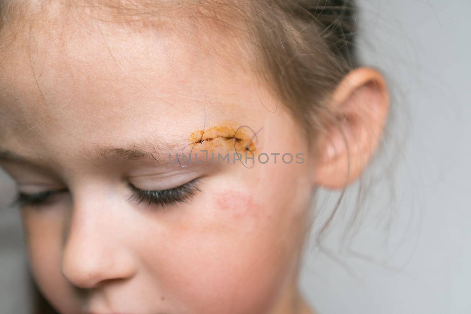 Close up sad, brave, drear cropped girl face with stitches on scratch of eyebrow dissection, looking down. Medicine aid and treatment. Pain relief and scar skin protection. Clean scar, wounds.