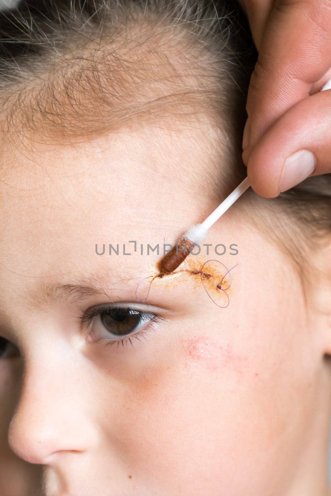 Vertical close up patient, tired child girl face with cropped man hand healing, apply Iodine on cotton swab to stitches on scratch. Clean scar, wounds. Children physical injuries and family abuse