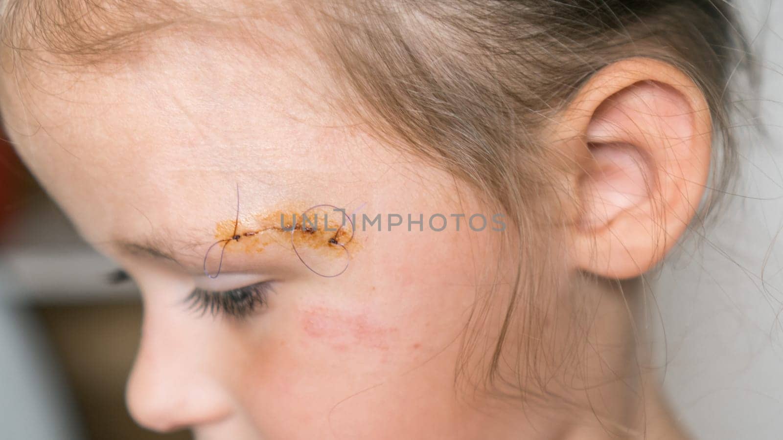 Close up sad, brave, drear cropped girl face with stitches on scratch of eyebrow dissection, looking down. Medicine aid and treatment. Pain relief and scar skin protection. Clean scar, wounds.