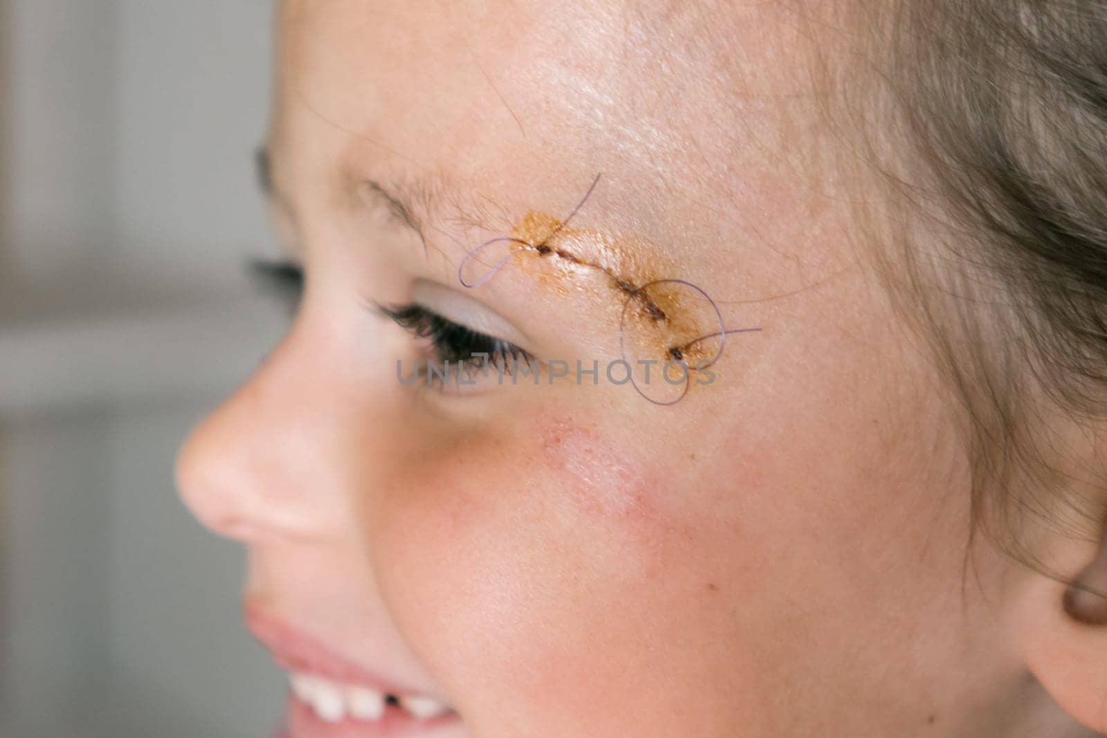Close up smiling patient kid girl face with stitches, joints on scratch of eyebrow dissection looking away. Clean scar, wounds. Pain relief and scar skin protection. Medicine aid and treatment