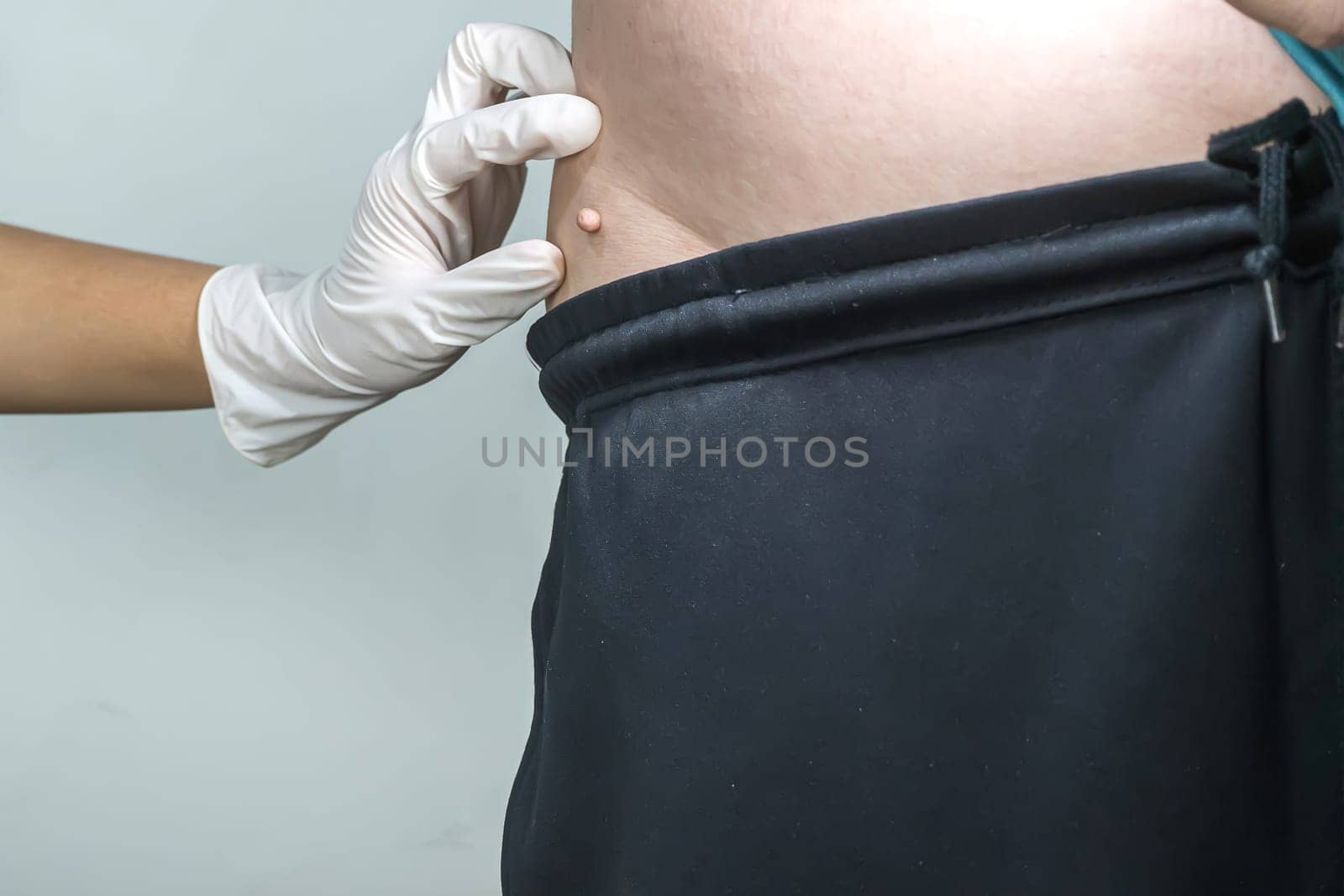 Skin tag or acrochondon or soft fibroma is a safe. It have not effect to the body. It usually occurs at neck, face, armpits and body.