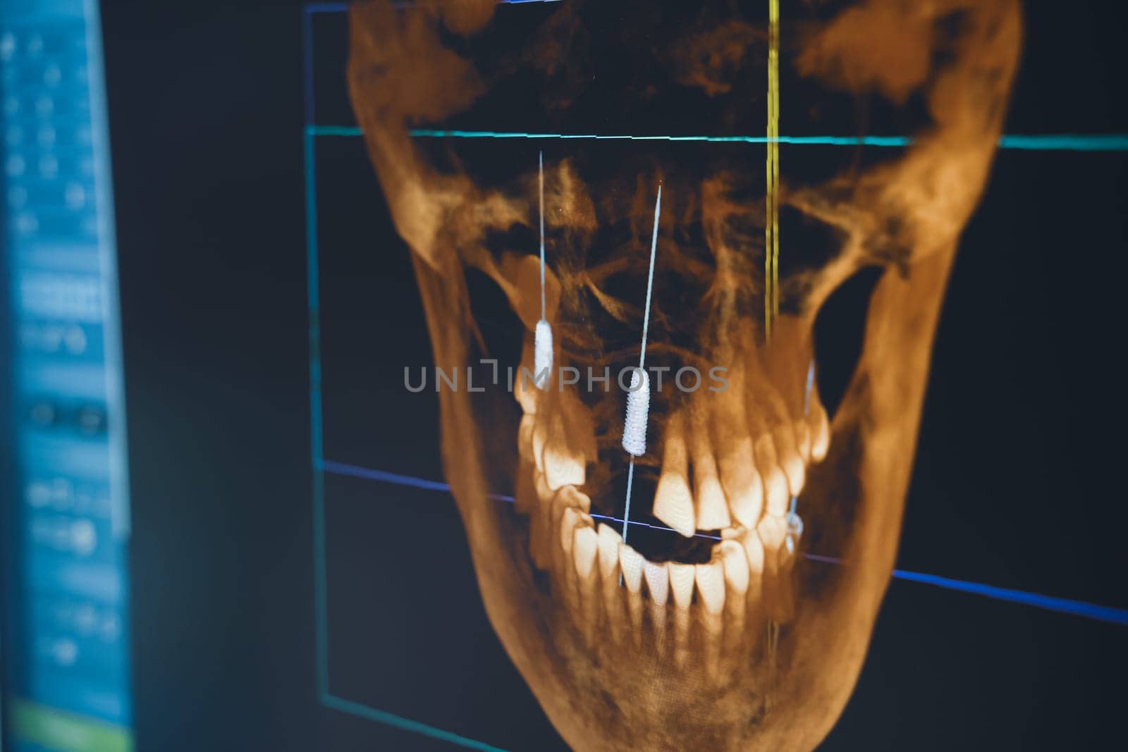 closeup of software interface of dental radiography x-ray on digital screen in dental clinic