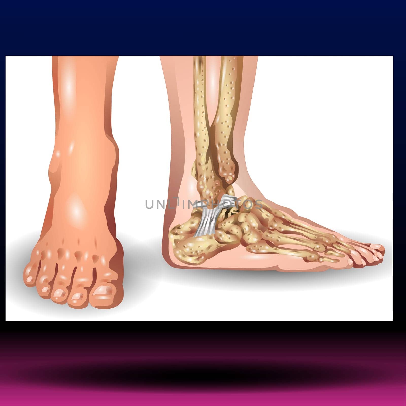 Foot and ankle pain. Vector illustration of human foot and ankle injury.