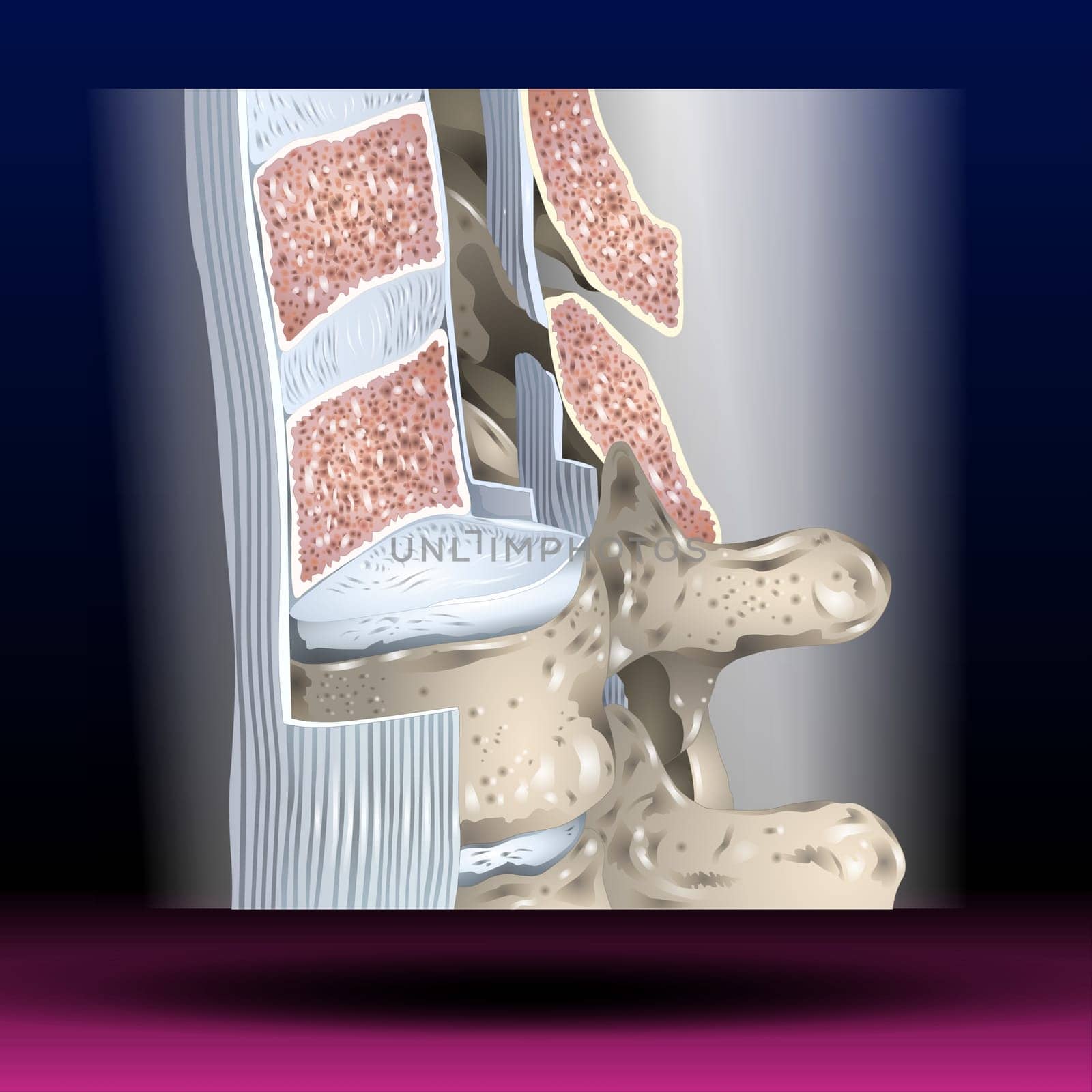 Anterior Longitudinal Ligament - Body Parts - Spine The anterior longitudinal ligament is a ligament that runs down the anterior surface of the spine.
