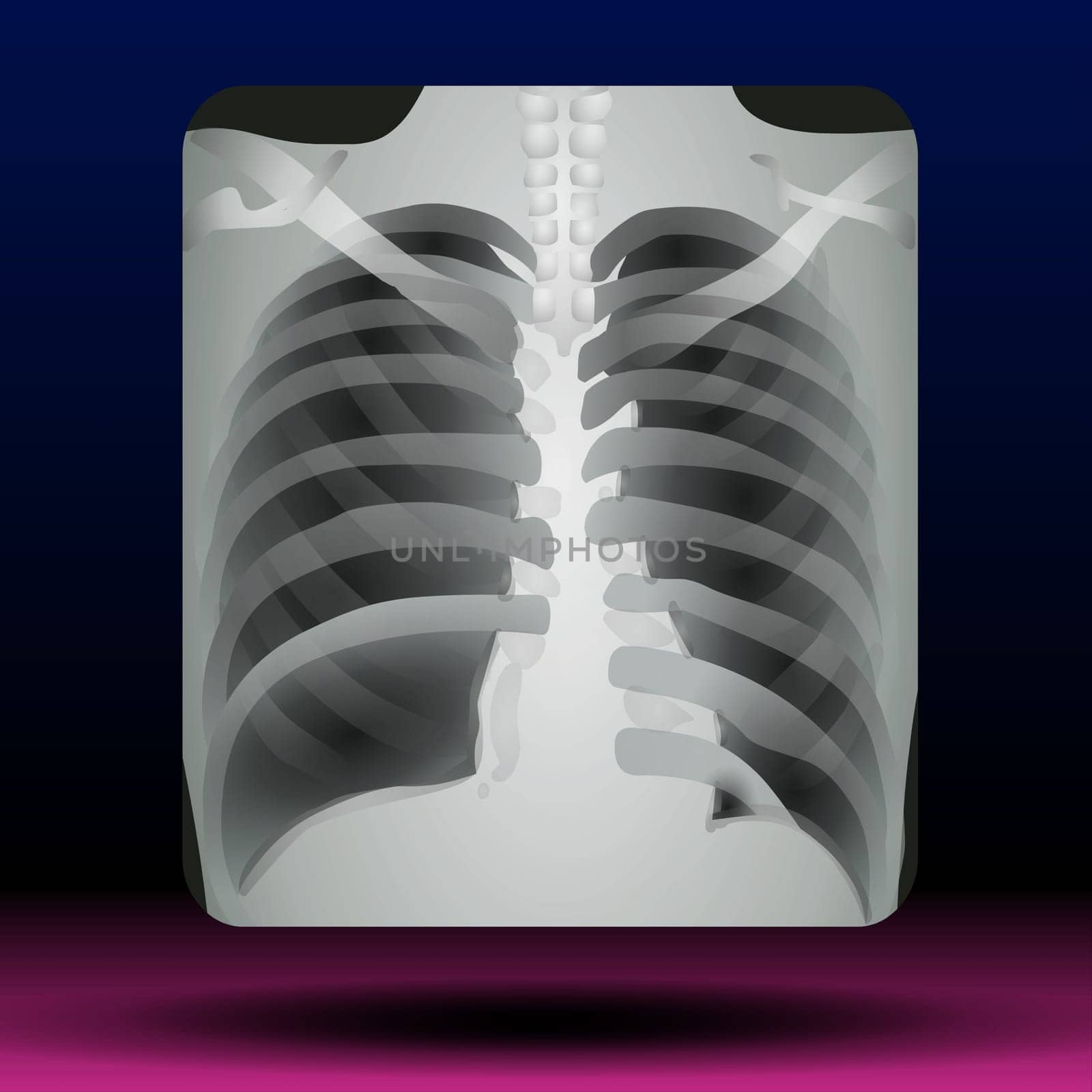 Illustration of X-ray of a human chest