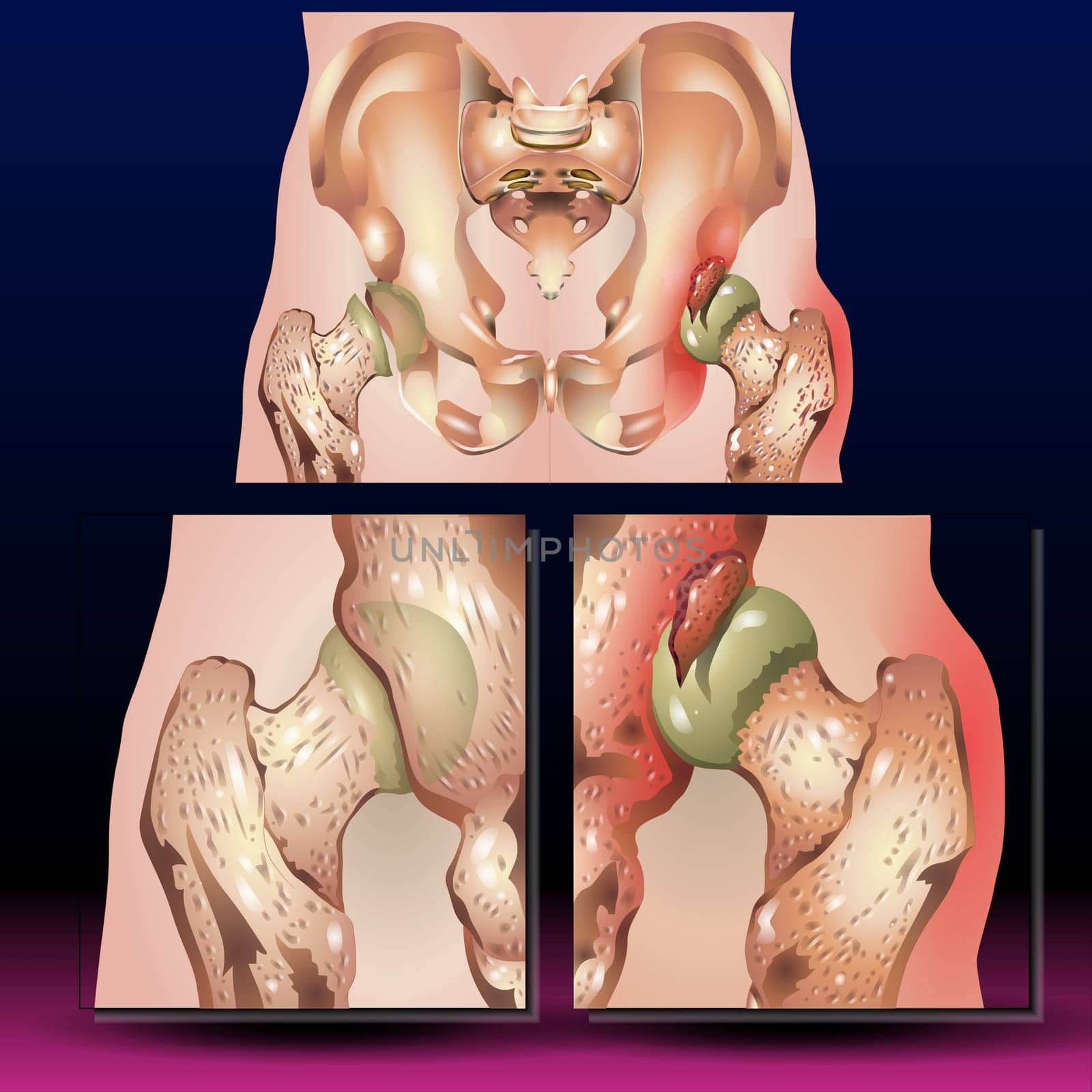 Patients with a posterior dislocation present with a limb adducted, flexed, internally rotated, and shortened.  Vector illustration of a pelvis hip fracture. hip dislocation