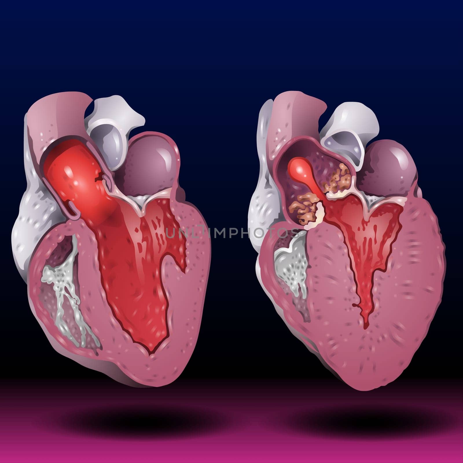 The heart is a muscular organ about the size of a fist, located just behind and slightly left of the breastbone. Anatomical muscular human pumps blood organ, cutaway internal organ with circulatory system. Vector Illustration
