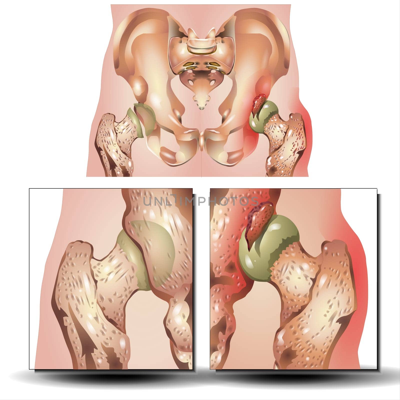 Patients with a posterior dislocation present with a limb adducted, flexed, internally rotated, and shortened.  Vector illustration of a pelvis hip fracture. hip dislocation