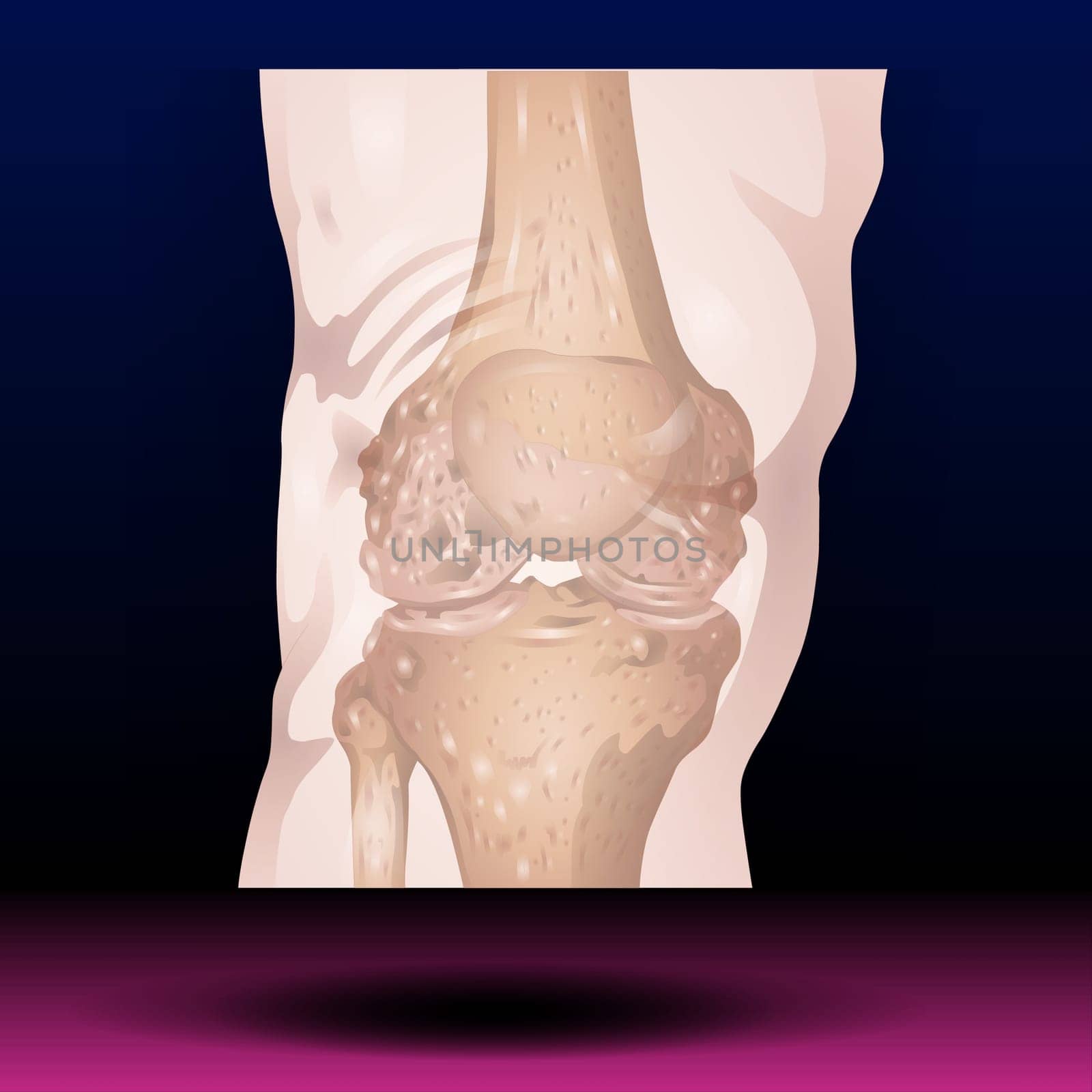 knee pain is a common complaint among adults and most often associated with general wear and tear from daily activities like walking, bending, standing and lifting. Vector Illustration