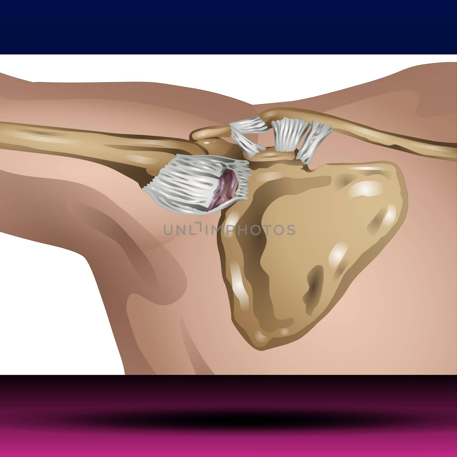 A dislocated shoulder is an injury in which the upper arm bone pops out of the cup-shaped socket that's part of the shoulder blade. The shoulder is the body's most flexible joint, which makes it more likely to dislocate. If you suspect a dislocated shoulder, seek prompt medical attention. Vector Illustration