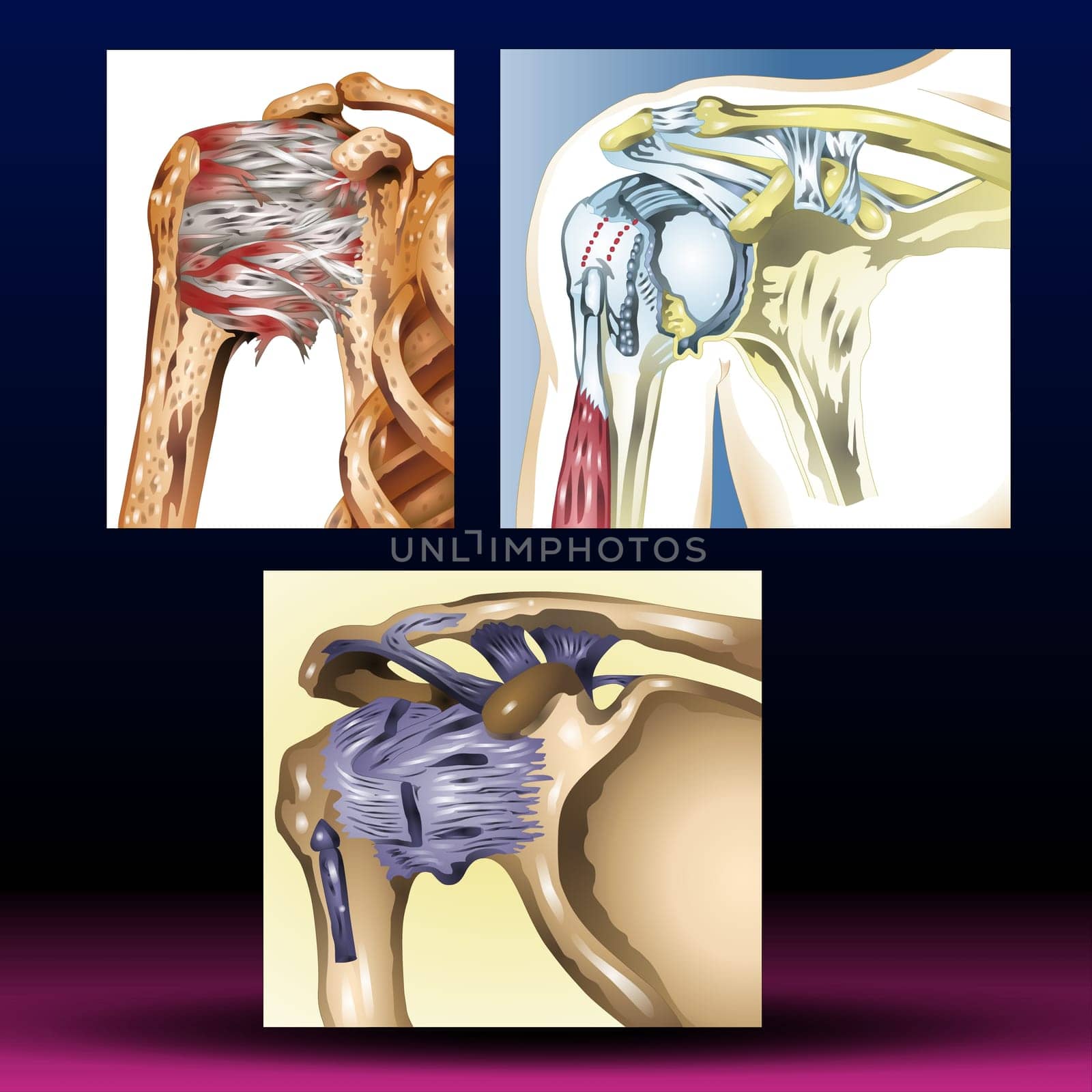 Frozen shoulder occurs when the connective tissue enclosing the joint thickens and tightens. Frozen shoulder, also called adhesive capsulitis, involves stiffness and pain in the shoulder joint. Signs and symptoms typically begin slowly, then get worse. Over time, symptoms get better, usually within 1 to 3 years. Vector Illustration