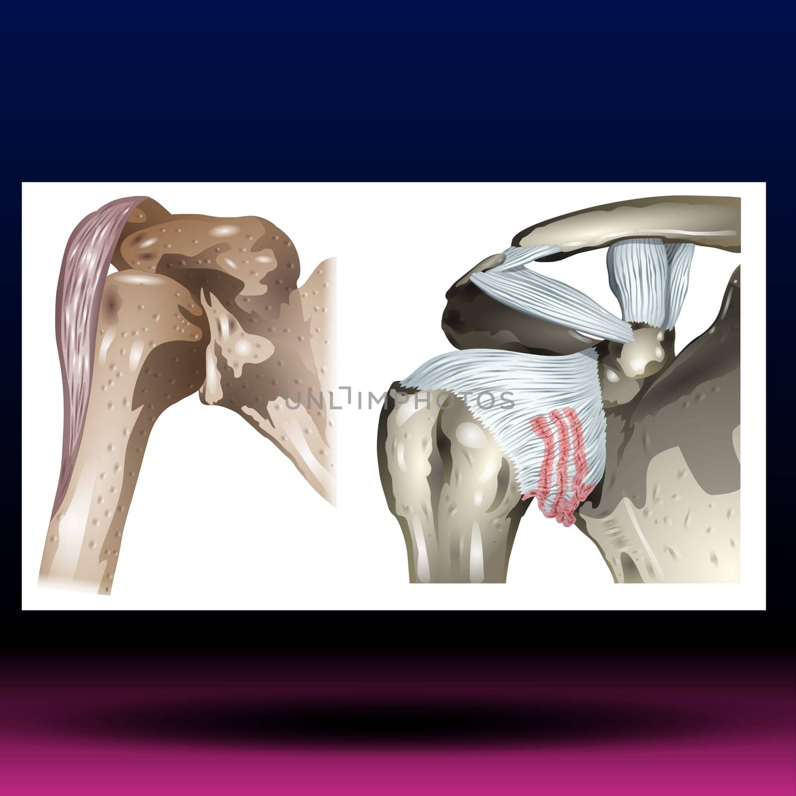 Frozen shoulder occurs when the connective tissue enclosing the joint thickens and tightens. Frozen shoulder, also called adhesive capsulitis, involves stiffness and pain in the shoulder joint. Signs and symptoms typically begin slowly, then get worse. Over time, symptoms get better, usually within 1 to 3 years.