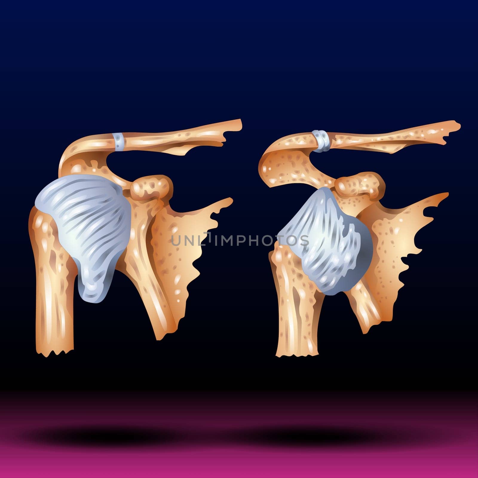 A dislocated shoulder is an injury in which the upper arm bone pops out of the cup-shaped socket that's part of the shoulder blade. The shoulder is the body's most flexible joint, which makes it more likely to dislocate. If you suspect a dislocated shoulder, seek prompt medical attention. Vector Illustration