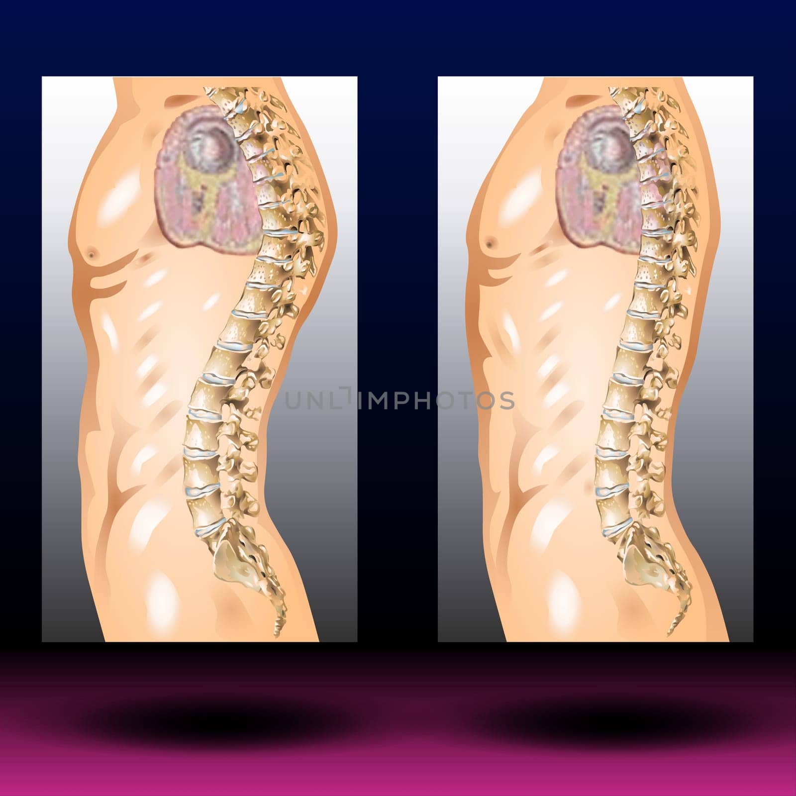 A forward rounding of the back. Hunchback (kyphosis) usually refers to an abnormally curved spine. It's most common in older women and often related to osteoporosis. Some people with kyphosis have back pain and stiffness. Others have no symptoms other than an exaggerated forward rounding of the back. Severe kyphosis can cause pain and be disfiguring. Treatment may include medication for pain, physiotherapy and sometimes surgery. Vector Illustration