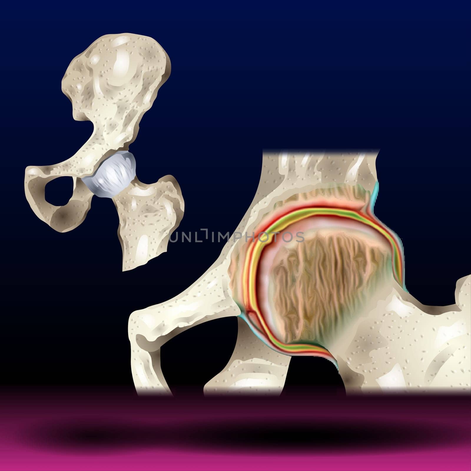 Knee joint with arthritis (Gout , Rheumatoid arthritis , Septic arthritis , Osteoarthritis knee) Vector Illustration
