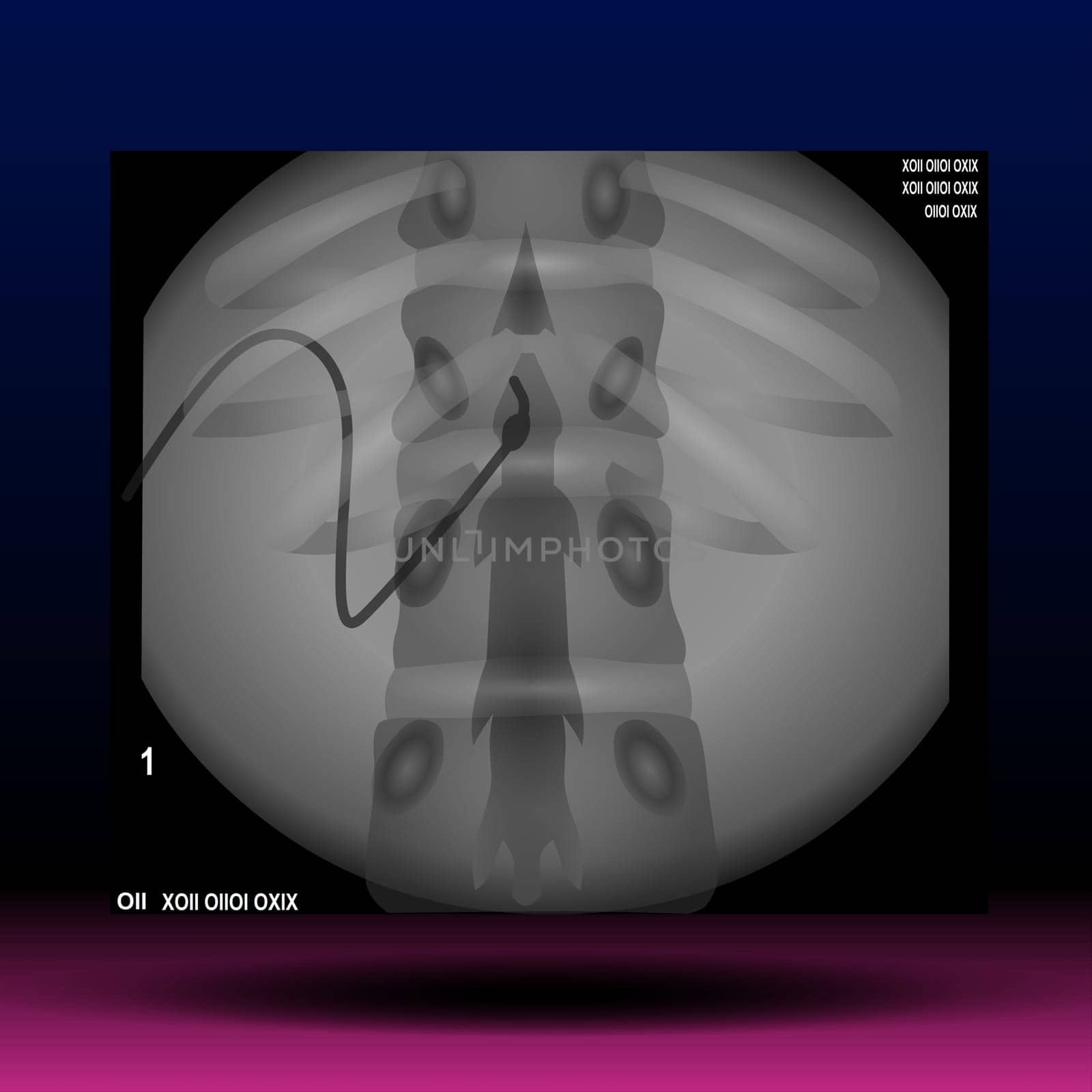 Scoliosis is an abnormal lateral curvature of the spine. Vector Illustration