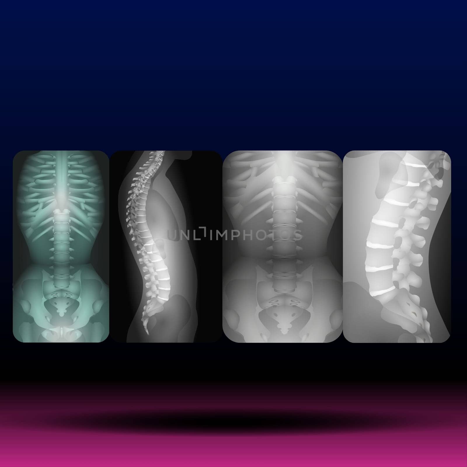 Scoliosis is an abnormal lateral curvature of the spine Vector Illustration